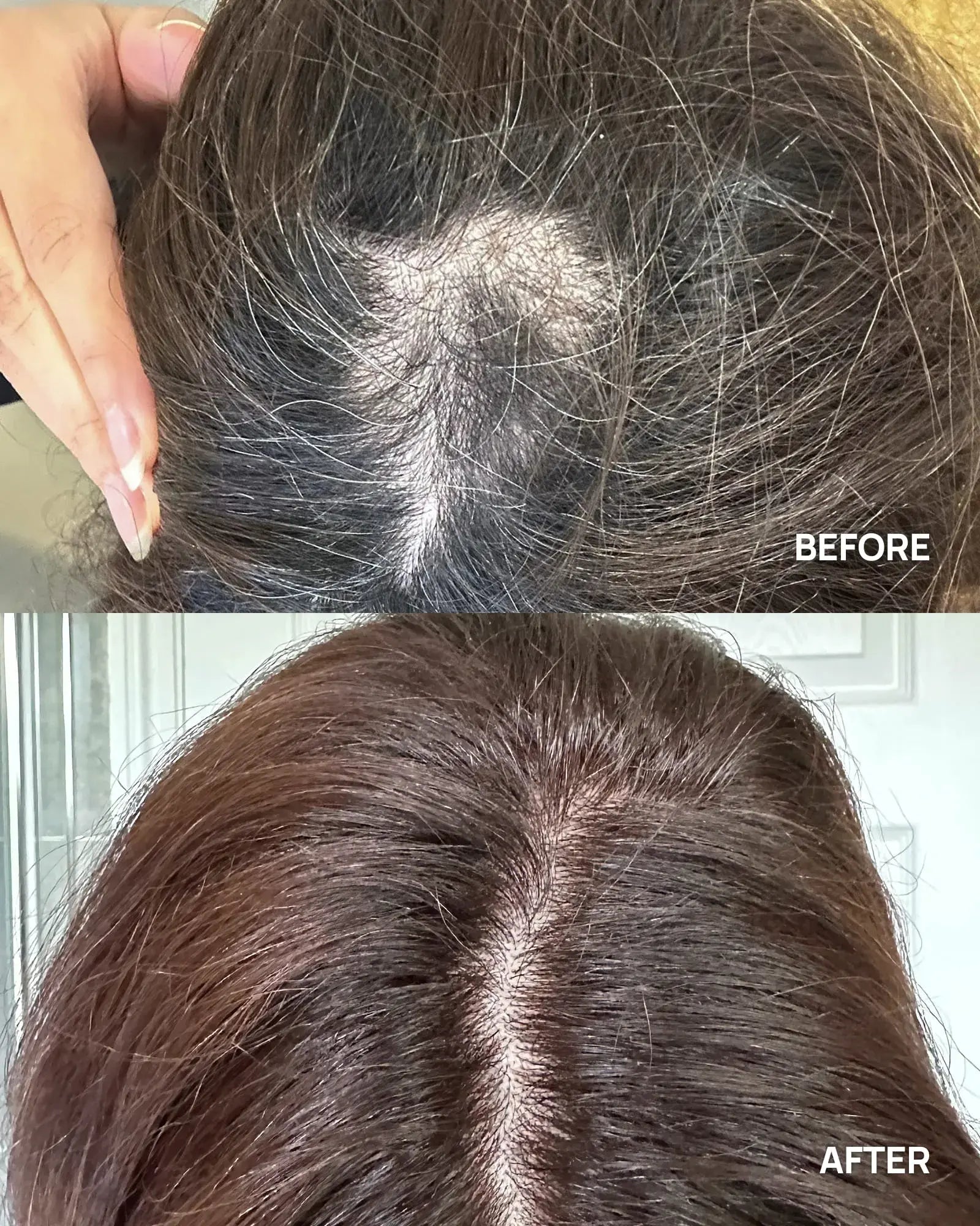 derma roller before after