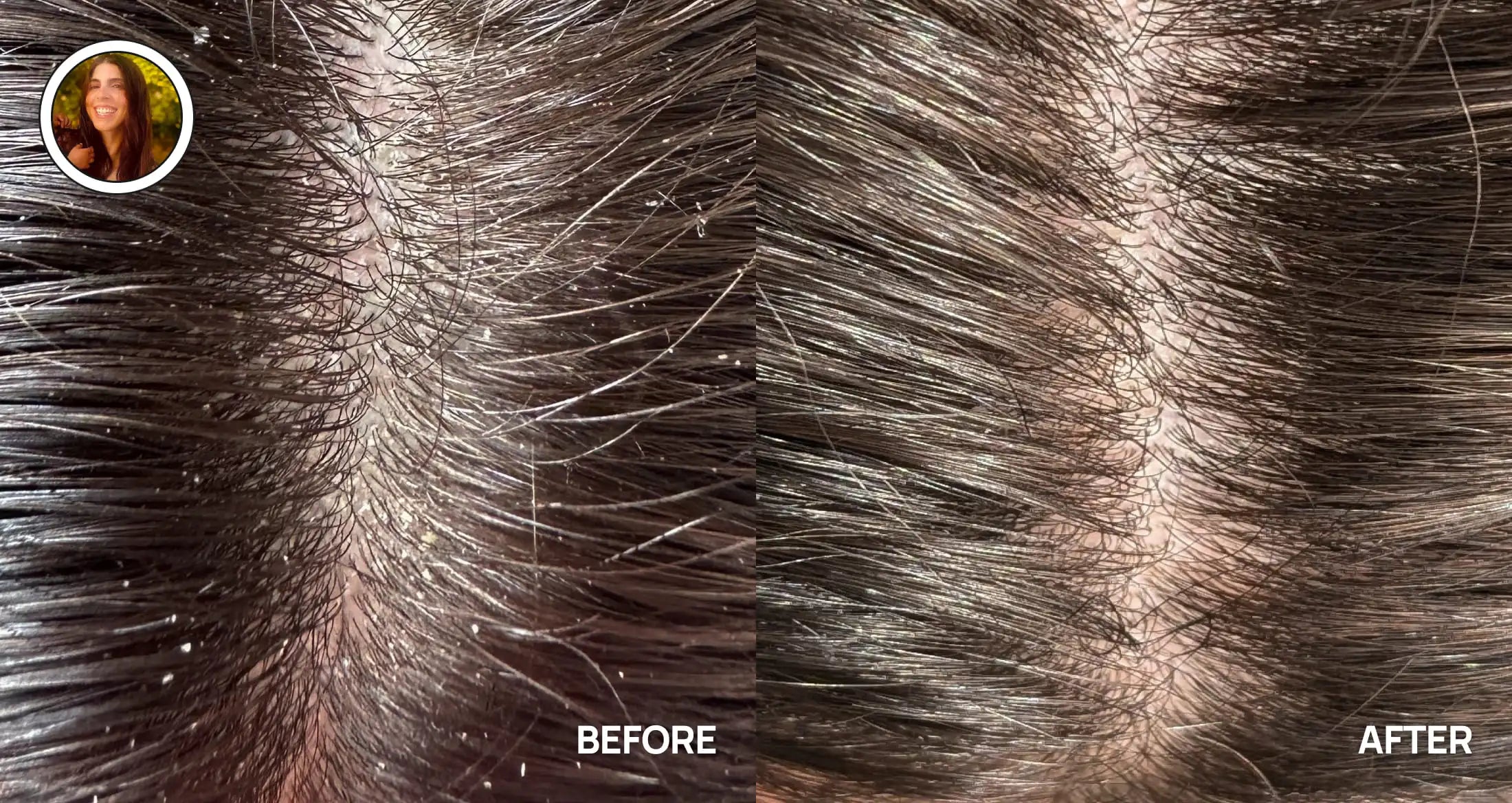 Before and after comparison of dandruff removal on a womans scalp.