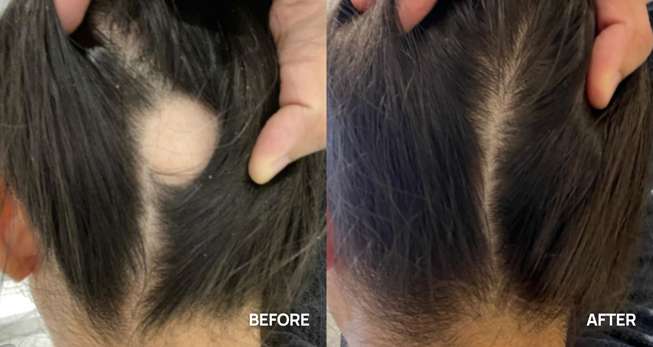 Woman before and after photo showing bald patch on head with new growth