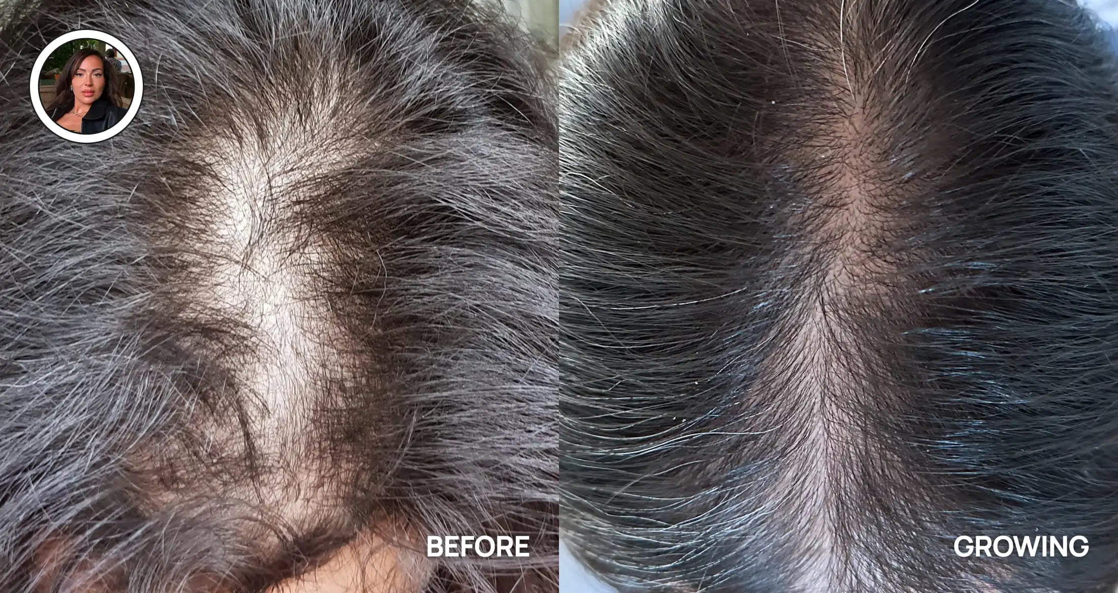 Before and after comparison of hair growth on a person's head.