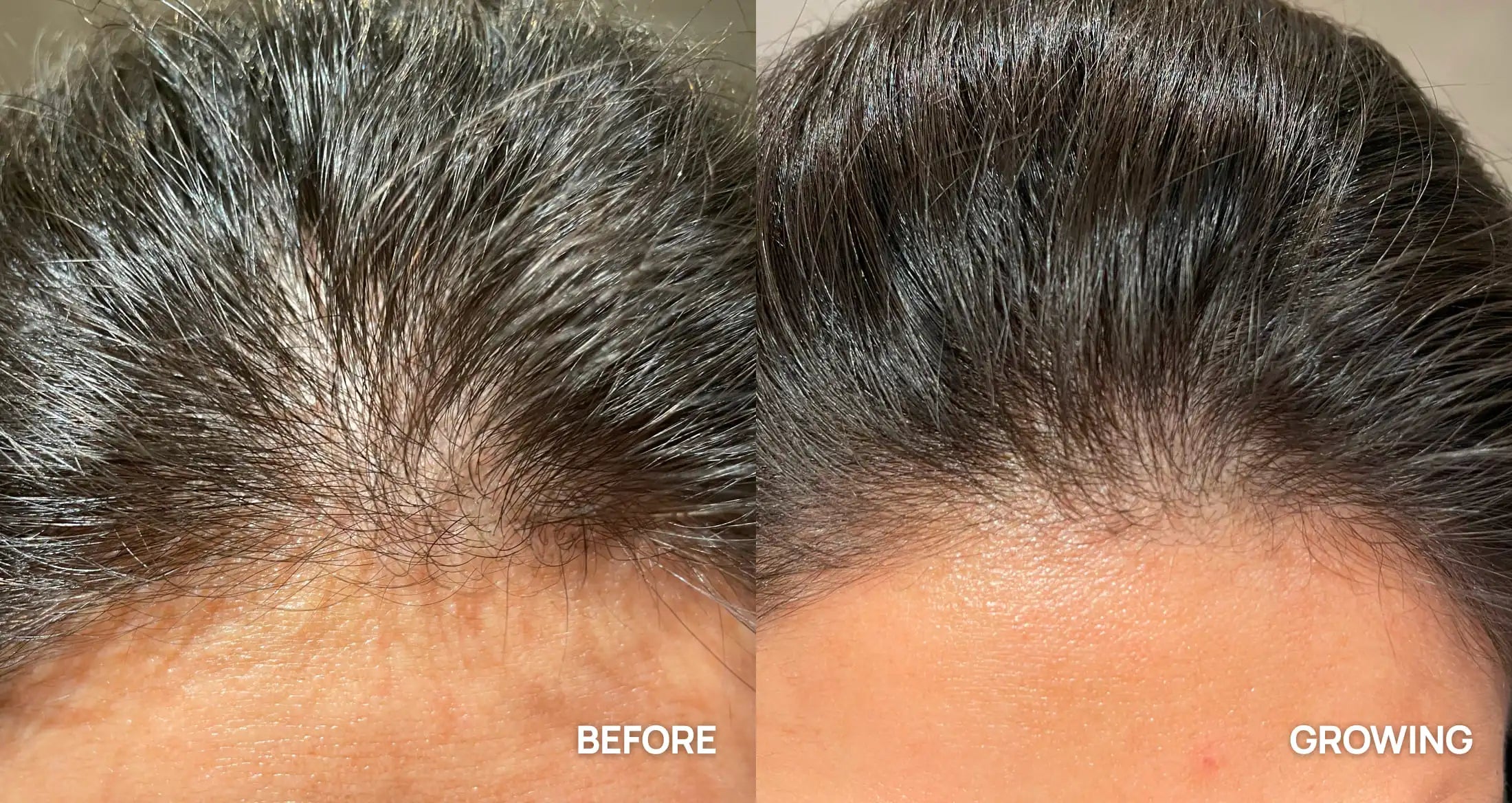 Before and after comparison of hair growth on a person's head.