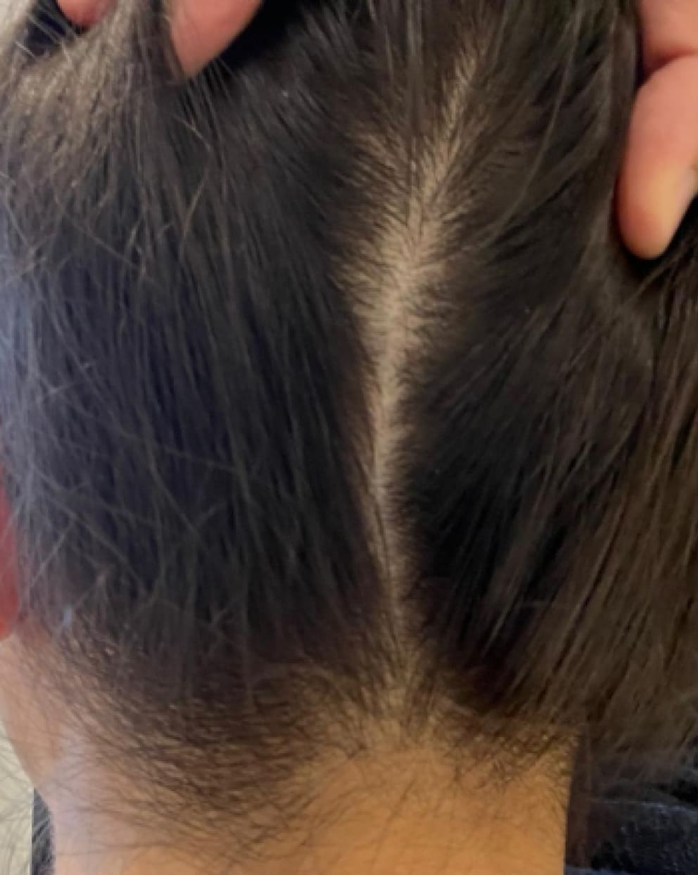 Close-up of a person's scalp with hair thinning on the sides.