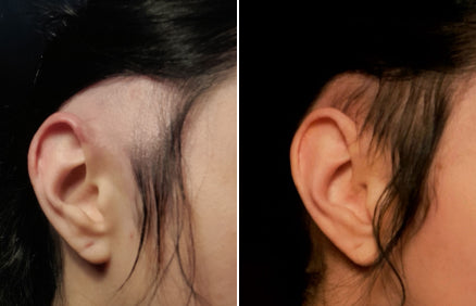 Before and after comparison of an ear with hair removal on a black background