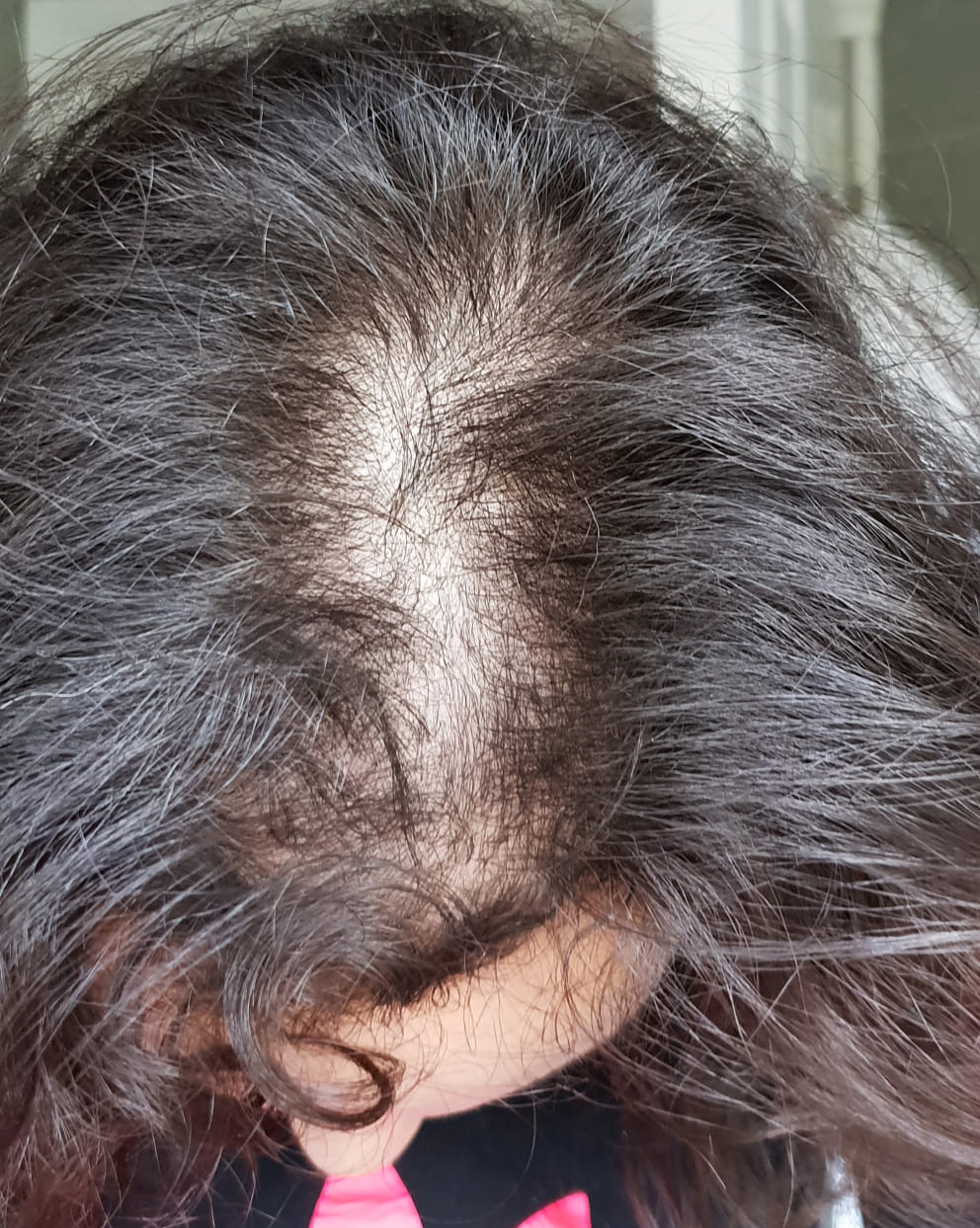 Close-up of a person with gray hair and visible scalp