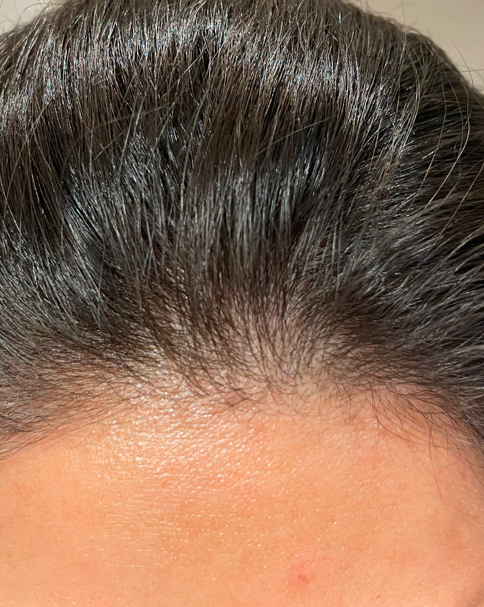 Close-up of a person's scalp with dark hair and visible skin texture.