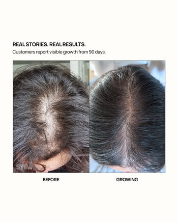 Before and after comparison of scalp using Syra Essence Scalp Mist showing thinning hair before and fuller-looking hair after