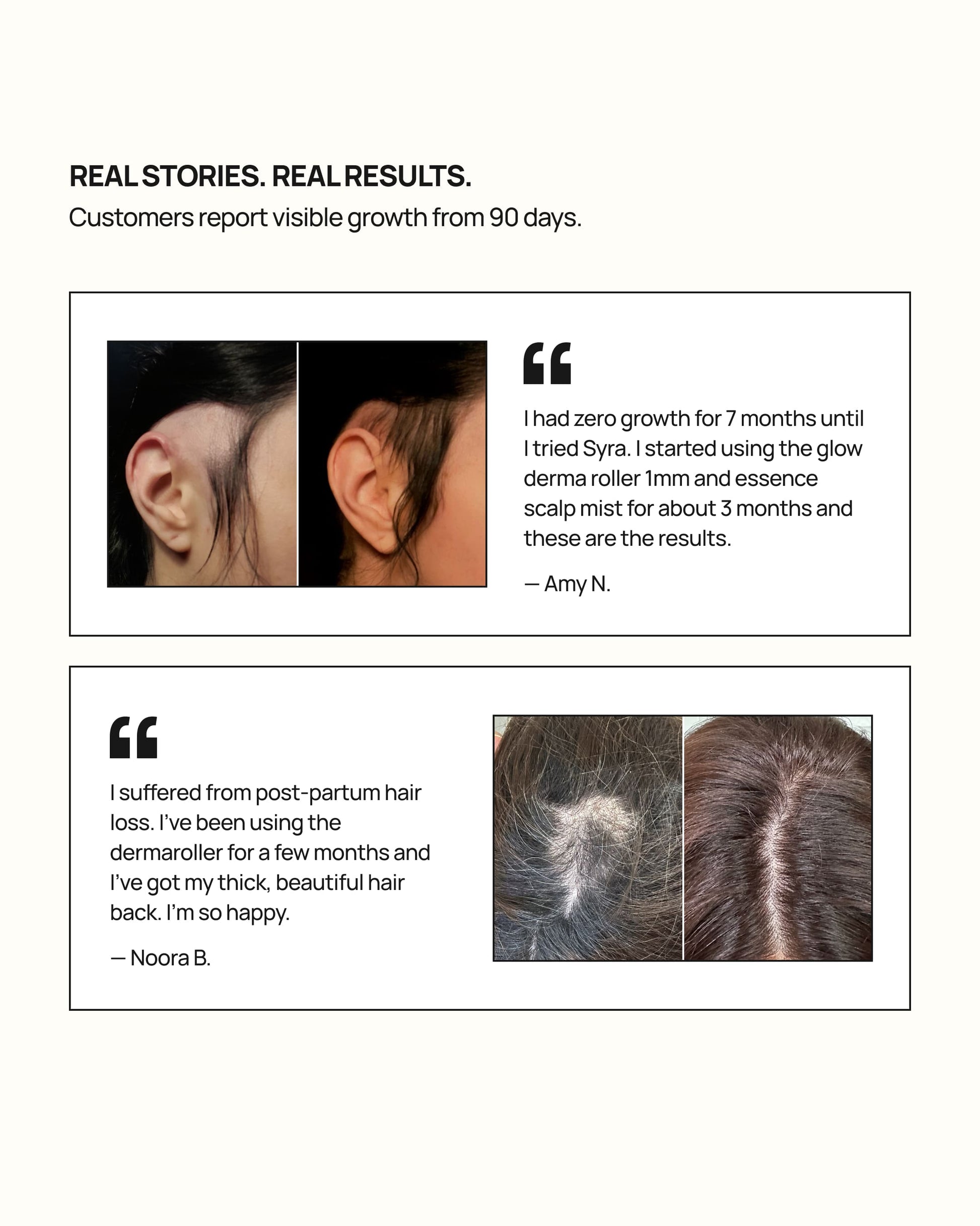 Syra customer testimonials with before and after hair comparison images showing reduced thinning and fuller-looking hair after using the glow dermaroller including a post-partum hair loss case