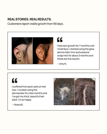 Syra customer testimonials with before and after hair comparison images showing reduced thinning and fuller-looking hair after using the glow dermaroller including a post-partum hair loss case
