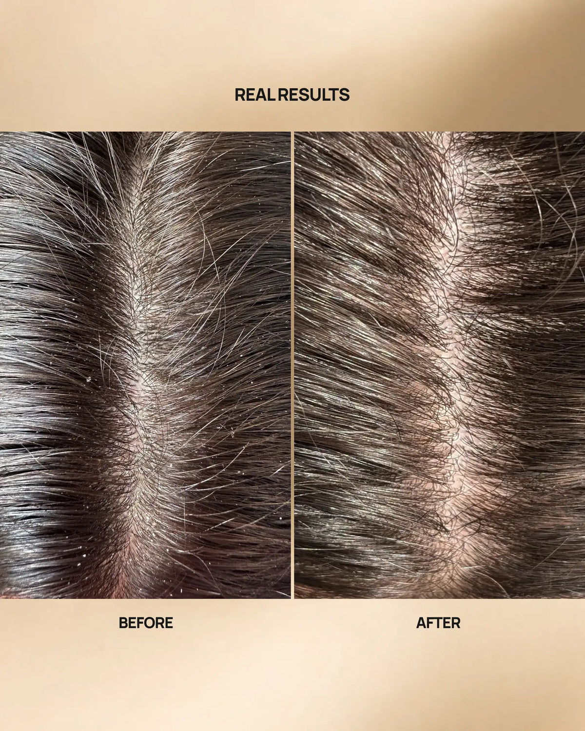 A before-and-after comparison of hair density and scalp visibility on dark brown to black hair, labeled 'REALRESULTS' at the top and 'BEFORE' and 'AFTER' at the bottom, set against a beige background.